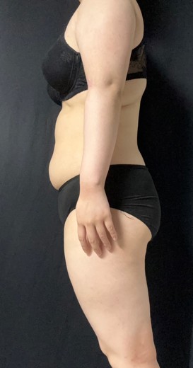 before photo: 전신지방흡입