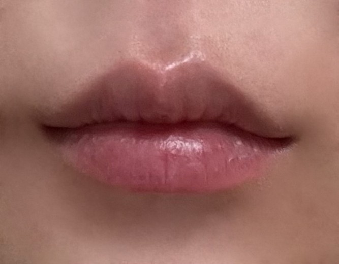 after photo: 입꼬리보톡스