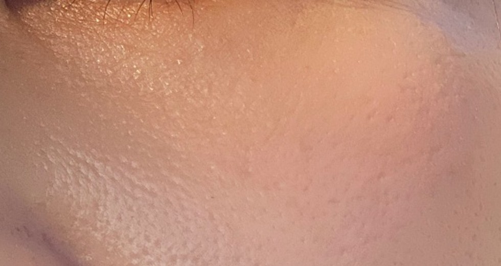 after photo: 리쥬란아이