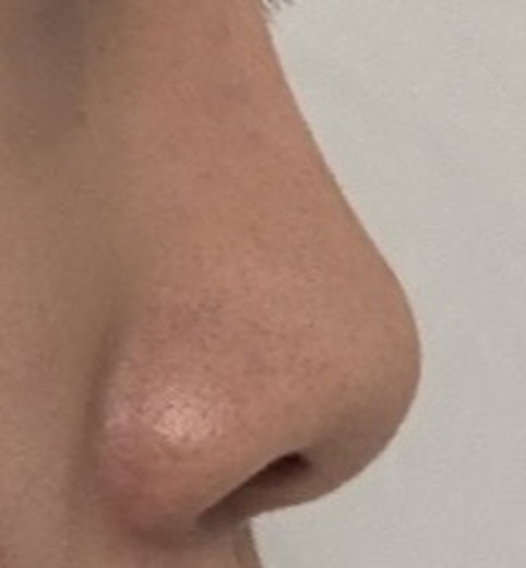 before photo: 콧대(보형물), 코끝(자가연골)