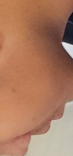 after photo: PDT레이저, 여드름압출