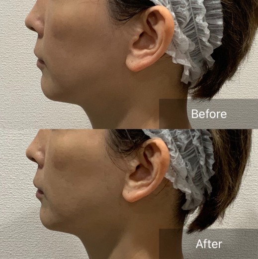 before photo: チタニウムリフト