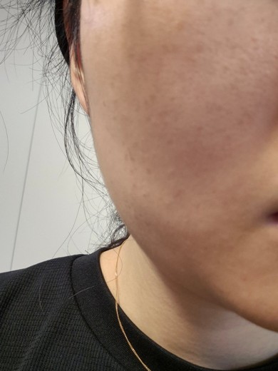 after photo: 레이저토닝