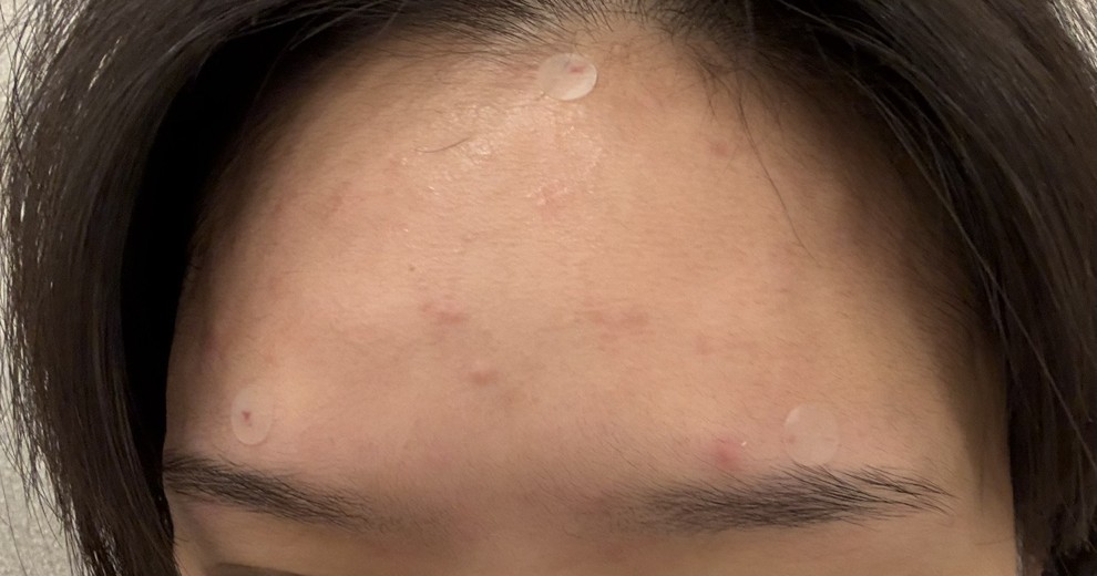 after photo: 이마필러, 관자놀이필러