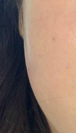 after photo: 옆볼필러