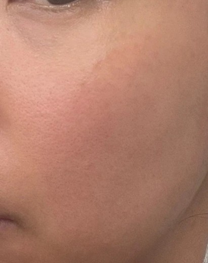 before photo: 보조개성형