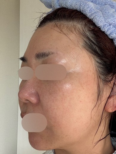 after photo: IPL(光/フォト治療), ルメッカ