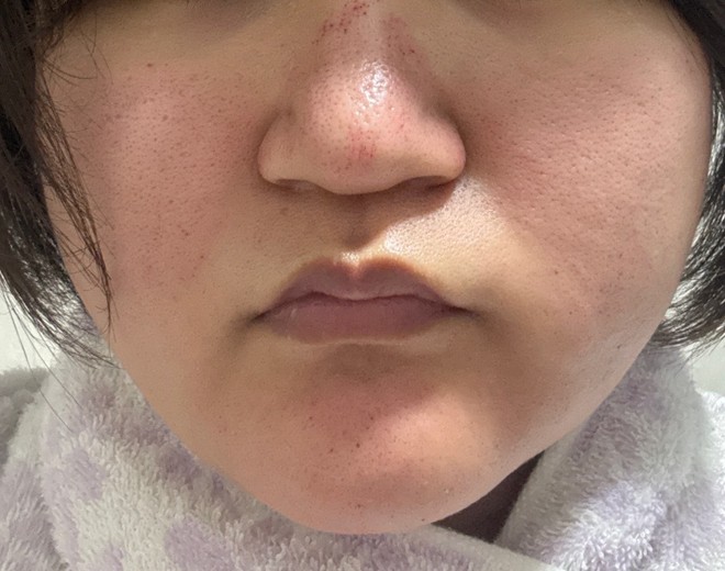 after photo: ダーマペン