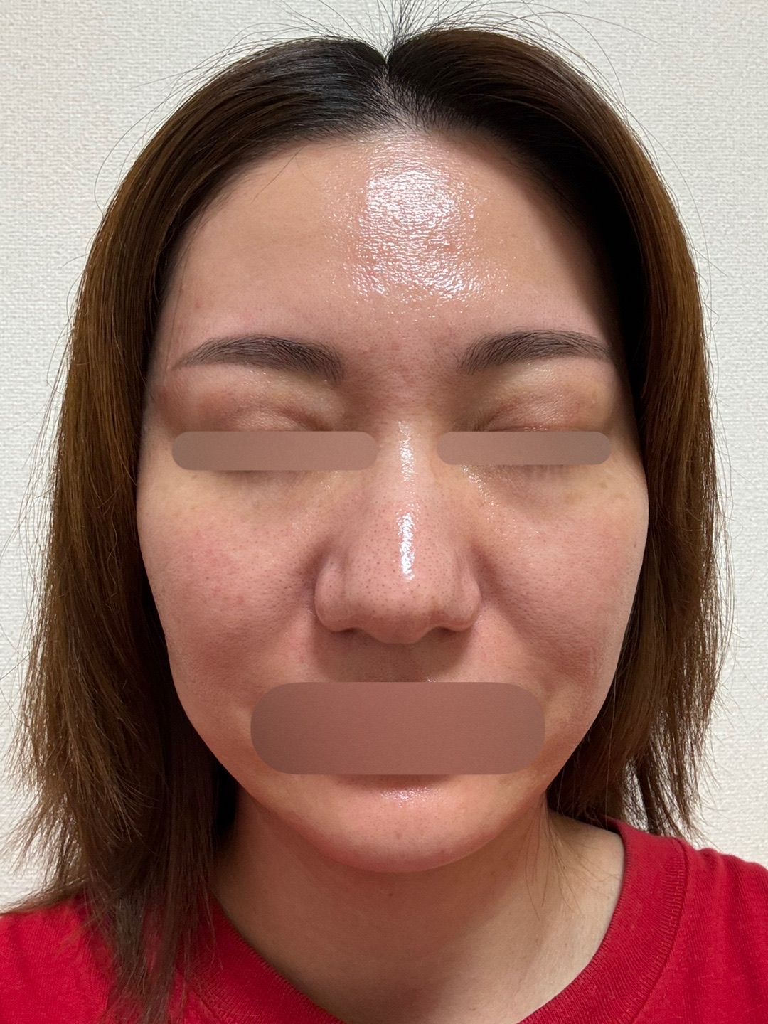 再来OK】コラーゲンピール＋イオン導入 | シティタワー新宿クリニック