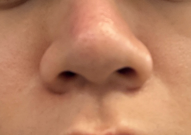 一代エレクトロポレーション　ハイドラフェイシャル 一代エレクトロポレーション ハイドラフェイシャル 一代