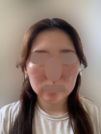 after photo: 脂肪溶解注射(顔)
