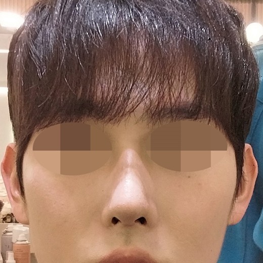 after photo: 콧대(자가조직), 코끝(자가연골)