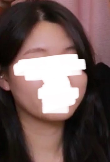 before photo: 윤곽주사