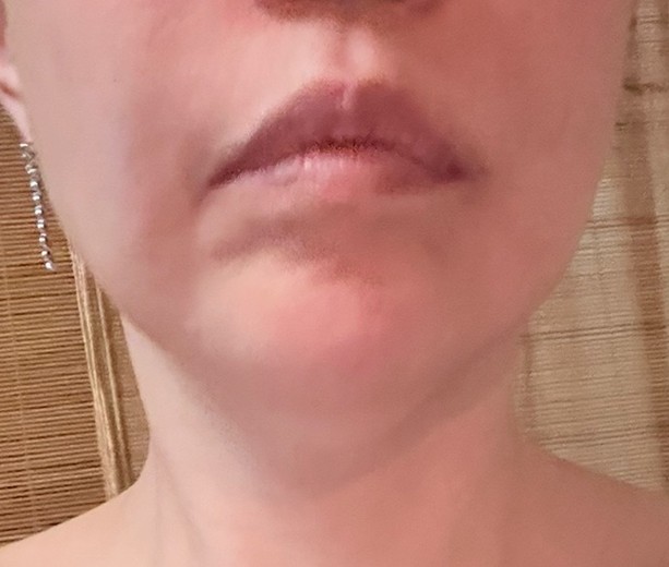 after photo: 脂肪溶解注射(顔)