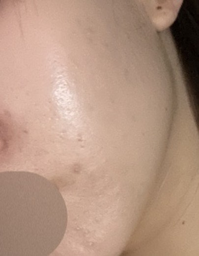 before photo: 피코토닝