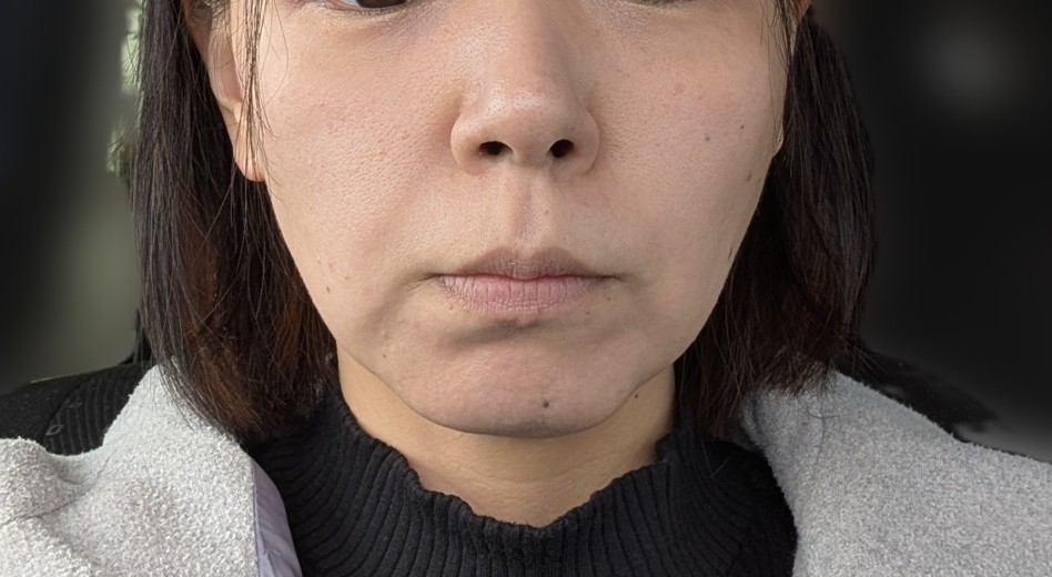 after photo: ハイフ(HIFU)