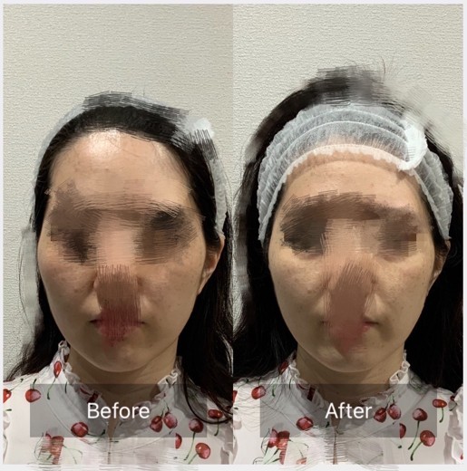 before photo: チタニウムリフト