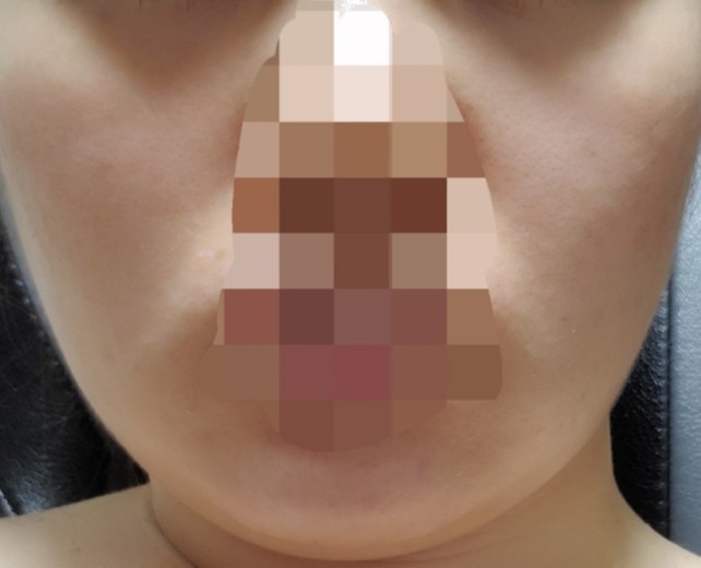 after photo: 脂肪溶解注射(顔)