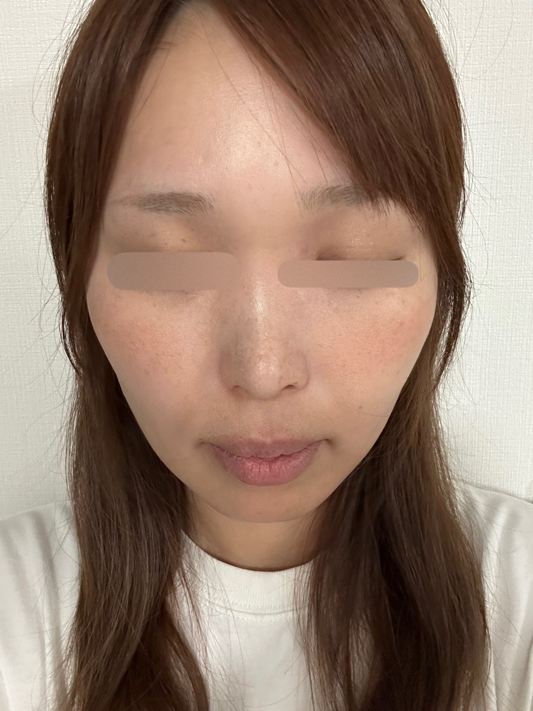 10月15日迄のご予約で初診料0円】全顔シミ取り放題＋美顔