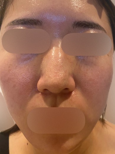 after photo: フラクショナルレーザー, ピコトーニング, 診断・検査
