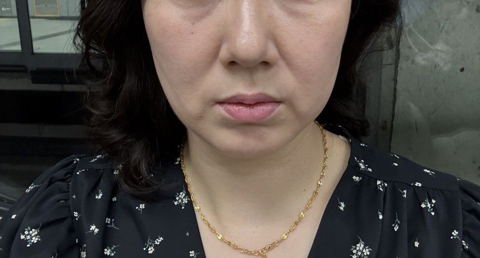 before photo: 스킨보톡스