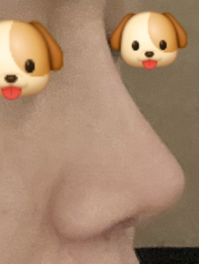 after photo: 콧대(보형물), 코끝(보형물)
