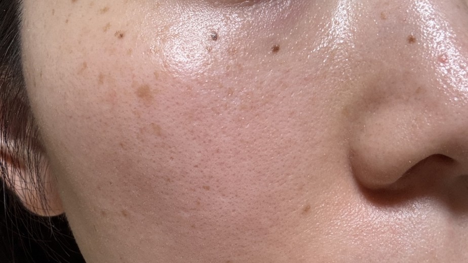 before photo: IPL(光/フォト治療)