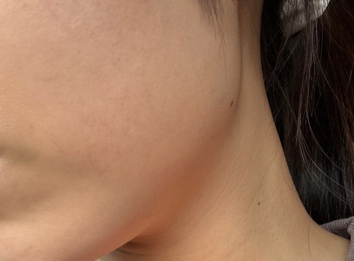 after photo: エラボトックス