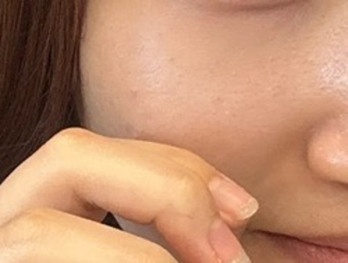 before photo: ダーマペン