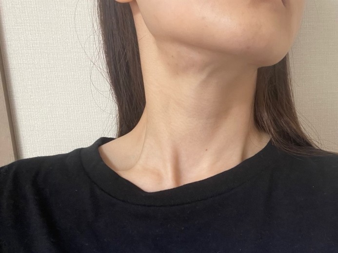 before photo: エラボトックス