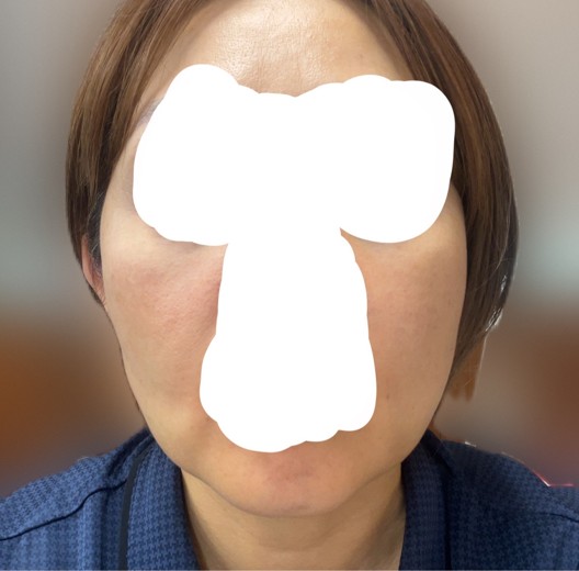 after photo: 脂肪溶解注射(顔)