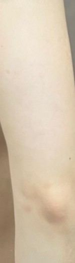 before photo: 脂肪溶解注射(腕)