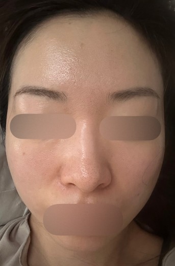 before photo: ハイドラフェイシャル