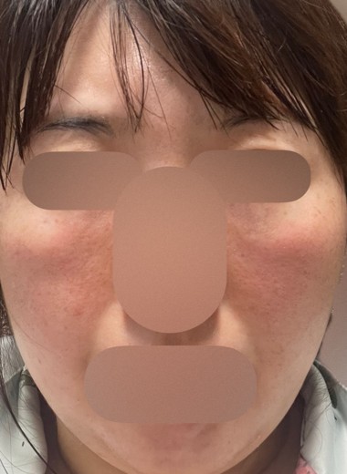 after photo: ミラノリピール