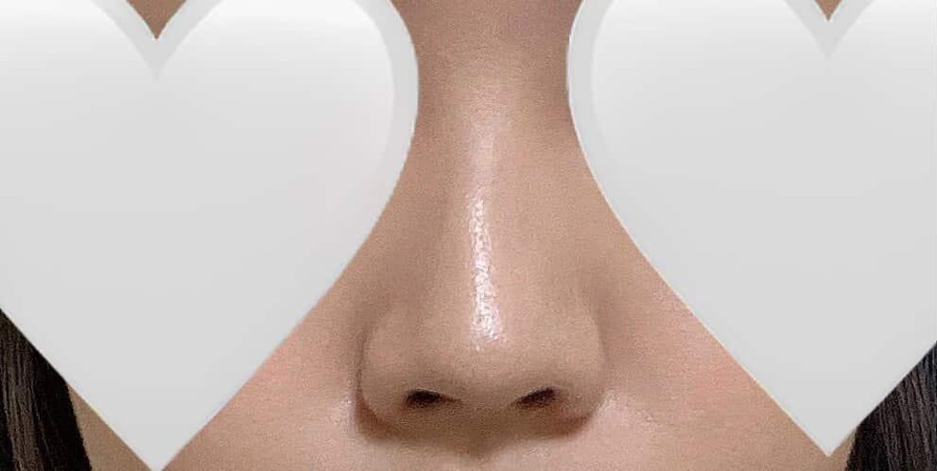 before photo: 콧대(보형물), 코끝(자가연골), 복코교정(수술)