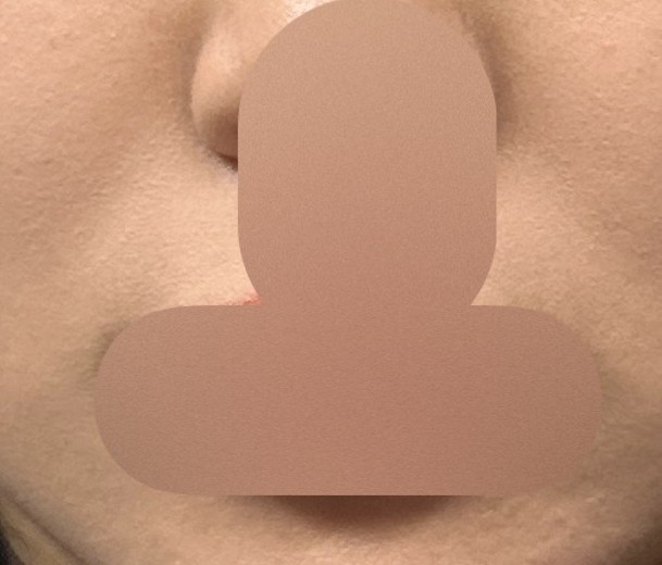 before photo: 팔자주름필러