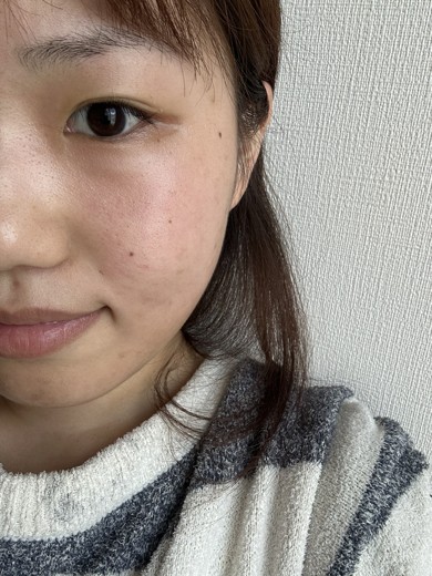after photo: イオン導入