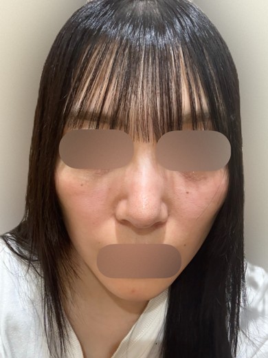 after photo: ピコフラクショナル