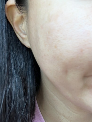 after photo: 턱필러