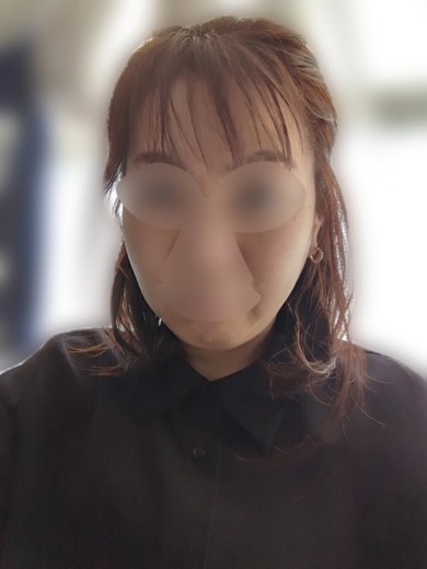 after photo: 脂肪溶解注射(顔)