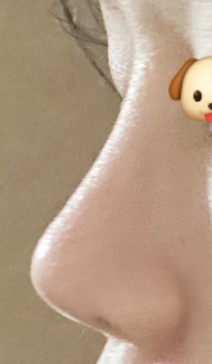 after photo: 콧대(보형물), 코끝(보형물)