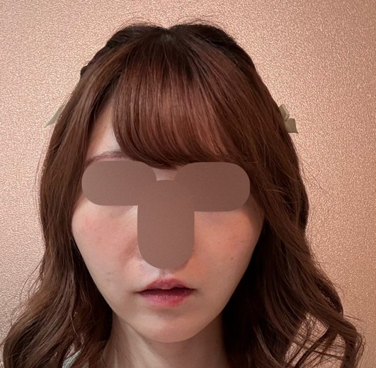 after photo: フラクショナルレーザー, エレクトロポレーション, Qスイッチレーザー