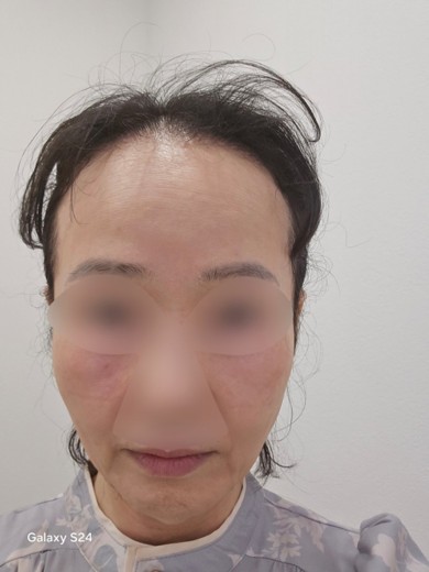 before photo: チタニウムリフト