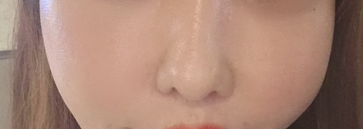 after photo: 스킨보톡스