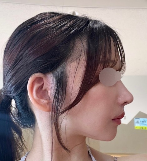 before photo: レーザートーニング