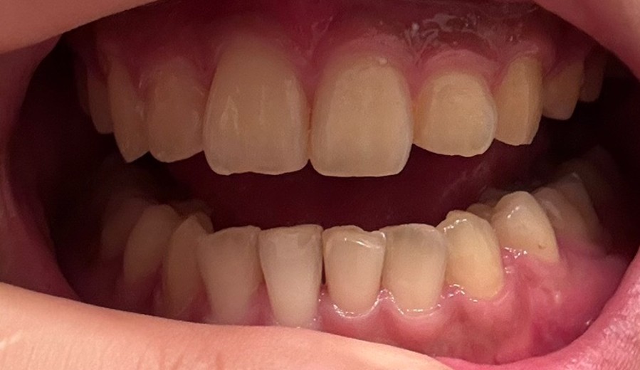 before photo: ホワイトニング