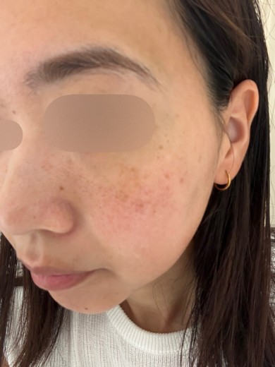 before photo: ピコトーニング