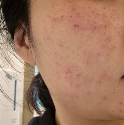 after photo: 레이저토닝