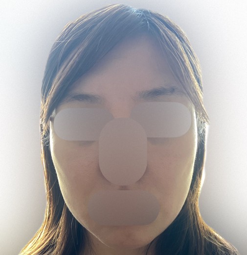 after photo: IPL(光/フォト治療)