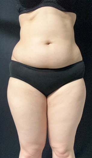 before photo: 전신지방흡입